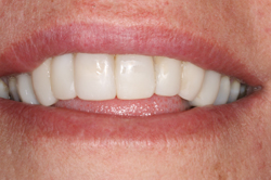 An even upper row