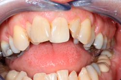 Jagged and uneven teeth